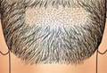 Picture of FUE Hair Treatment. Where grafts are removed.