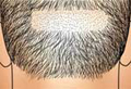 Picture of FUE Hair Treatment. Back of head.