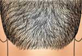 Picture of FUE Hair Treatment. The donor area.